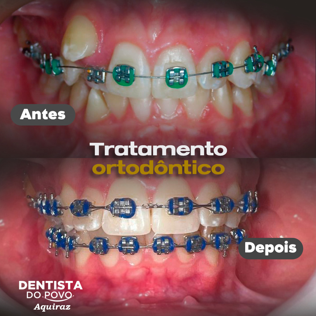 Aparelhos - ortodônticos - 2 - 1080
