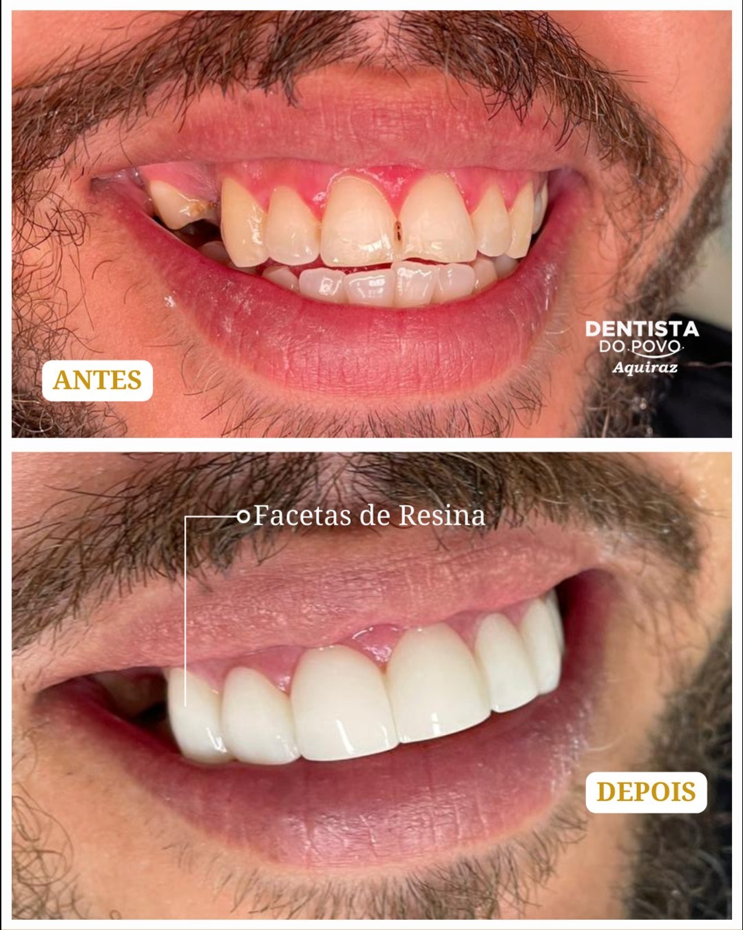 Facetas em resina - 4 - 1080