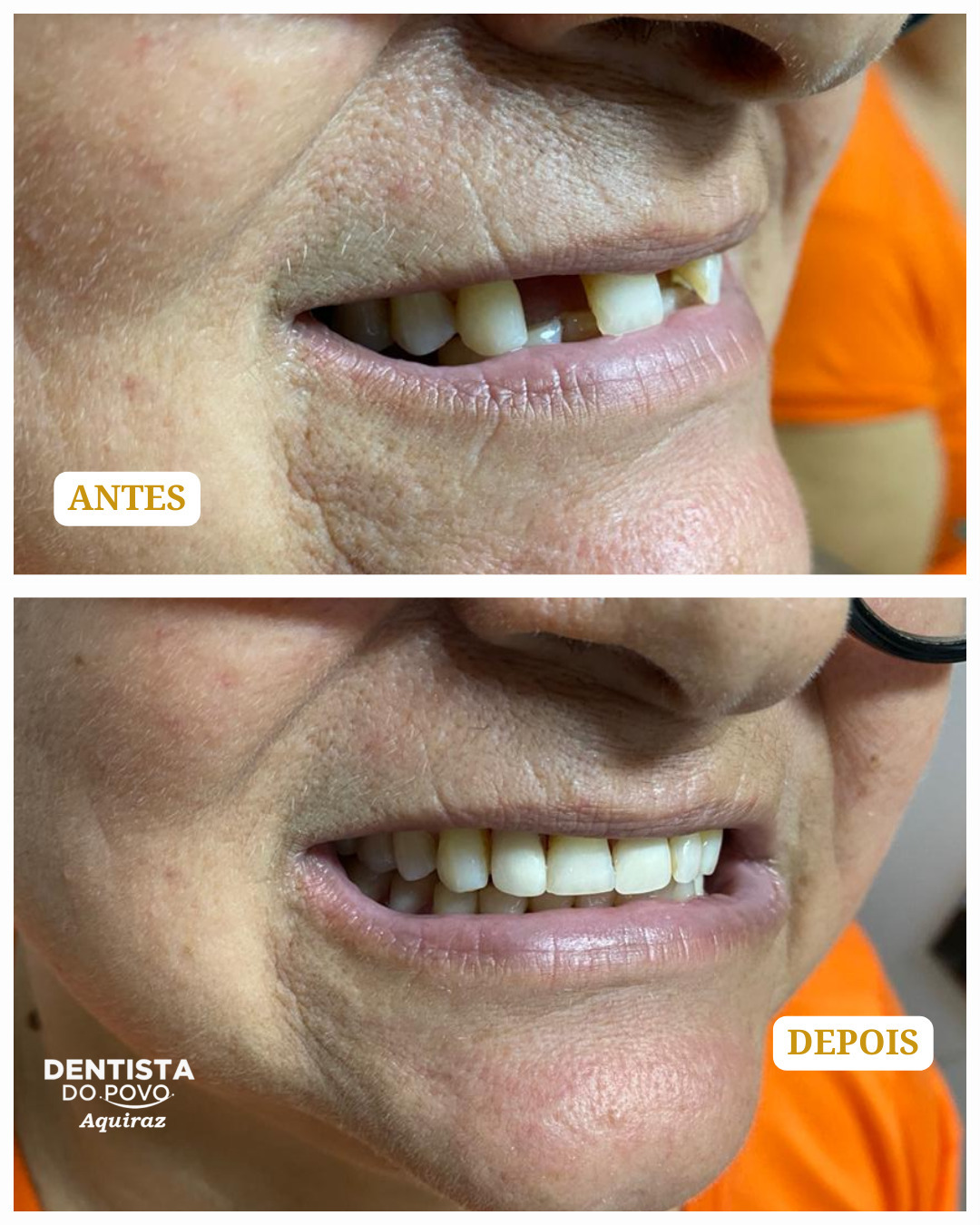 Implantes - 02 - 1080