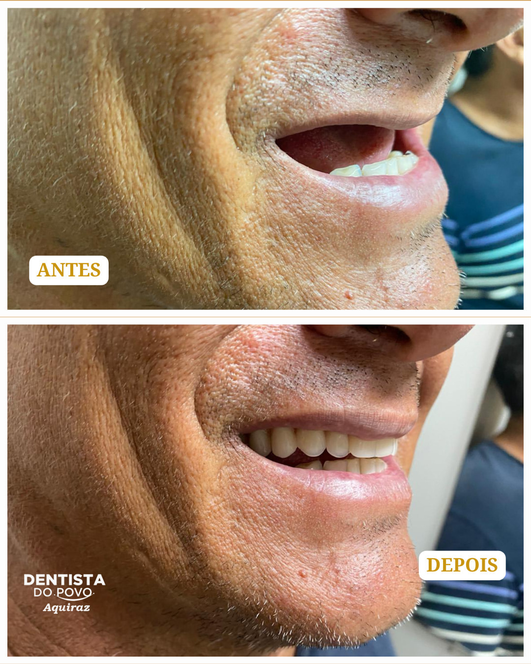 Implantes - 03 - 1080