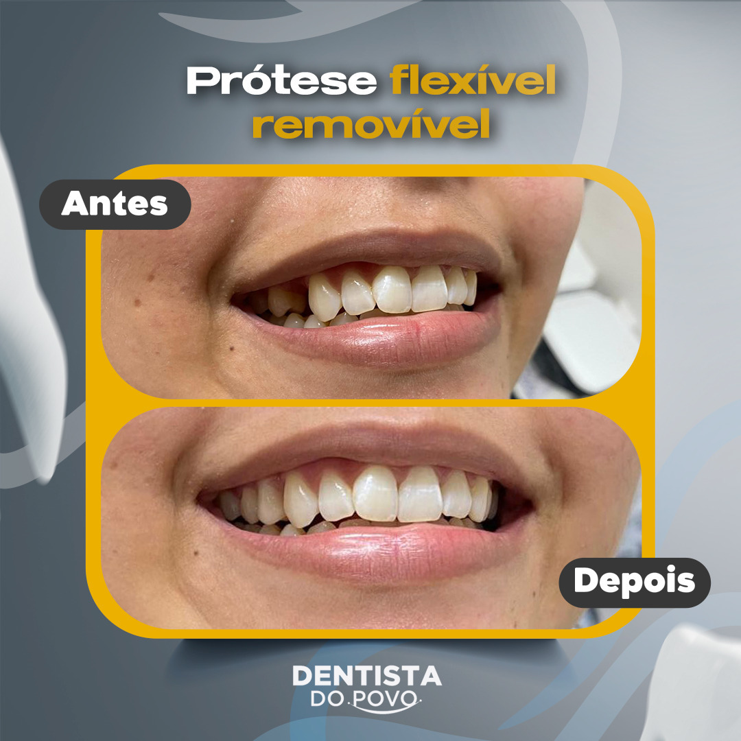Protese flexivel removivel - 1 - 1080