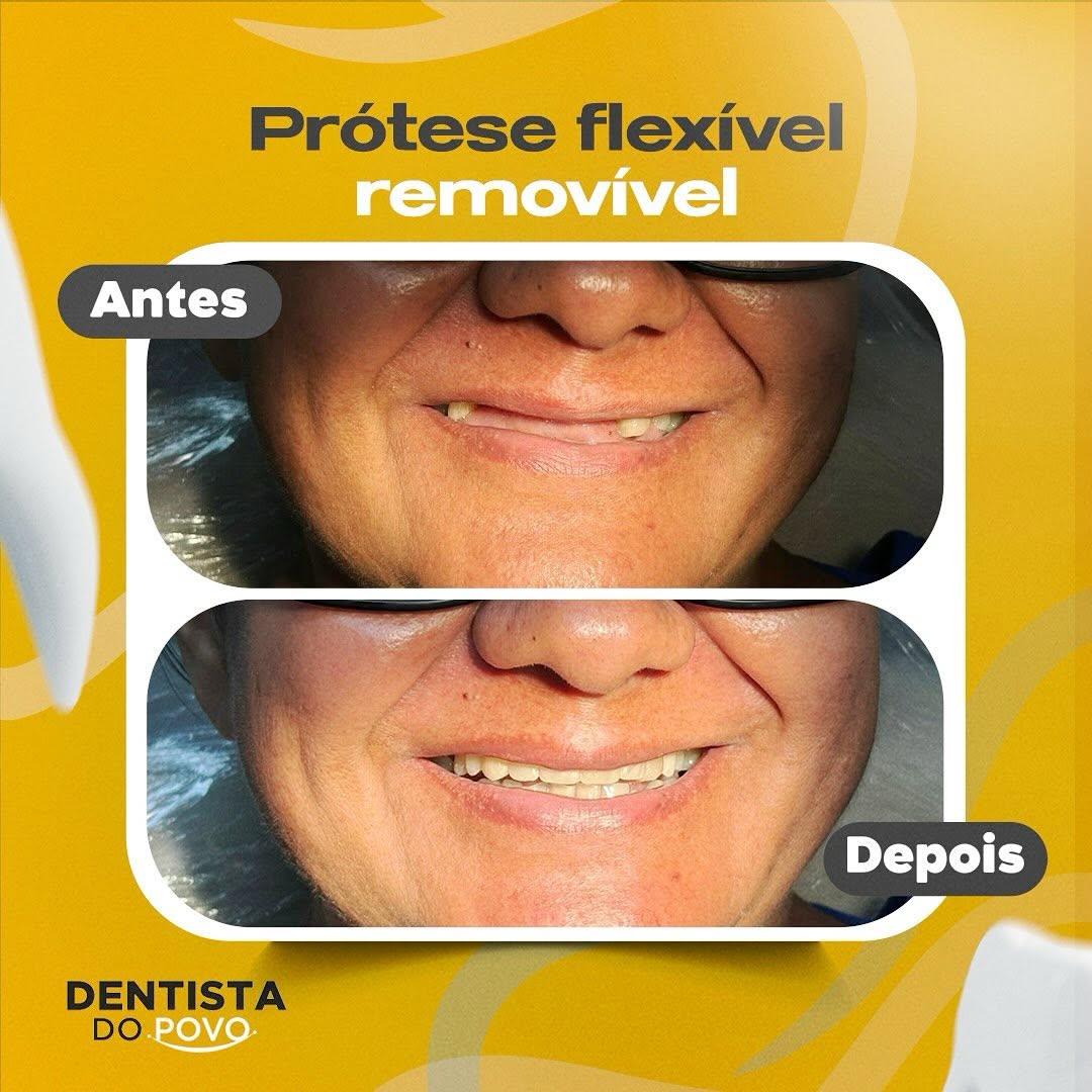 Protese flexivel removivel - 2 - 1080